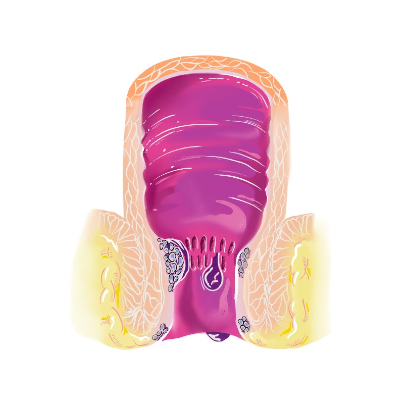 Schematic drawing showing enlarged vascular structures around the anal canal